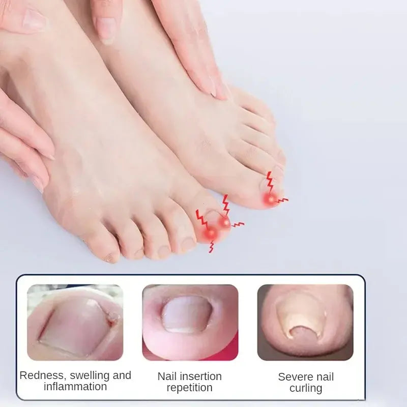 Profession elles Fußpflege-Korrektur werkzeug ein gewachsene Zehennagel-Korrektor-Werkzeuge Pediküre erholen eingebettete Zehen nagel behandlung Pflege Fuß werkzeug