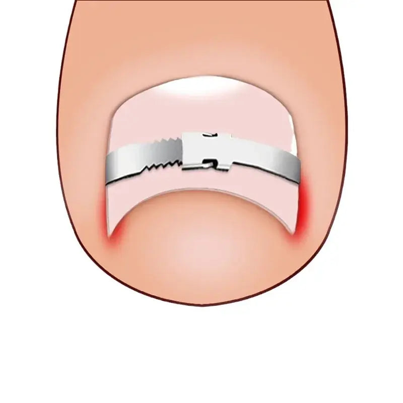 Profession elles Fußpflege-Korrektur werkzeug ein gewachsene Zehennagel-Korrektor-Werkzeuge Pediküre erholen eingebettete Zehen nagel behandlung Pflege Fuß werkzeug