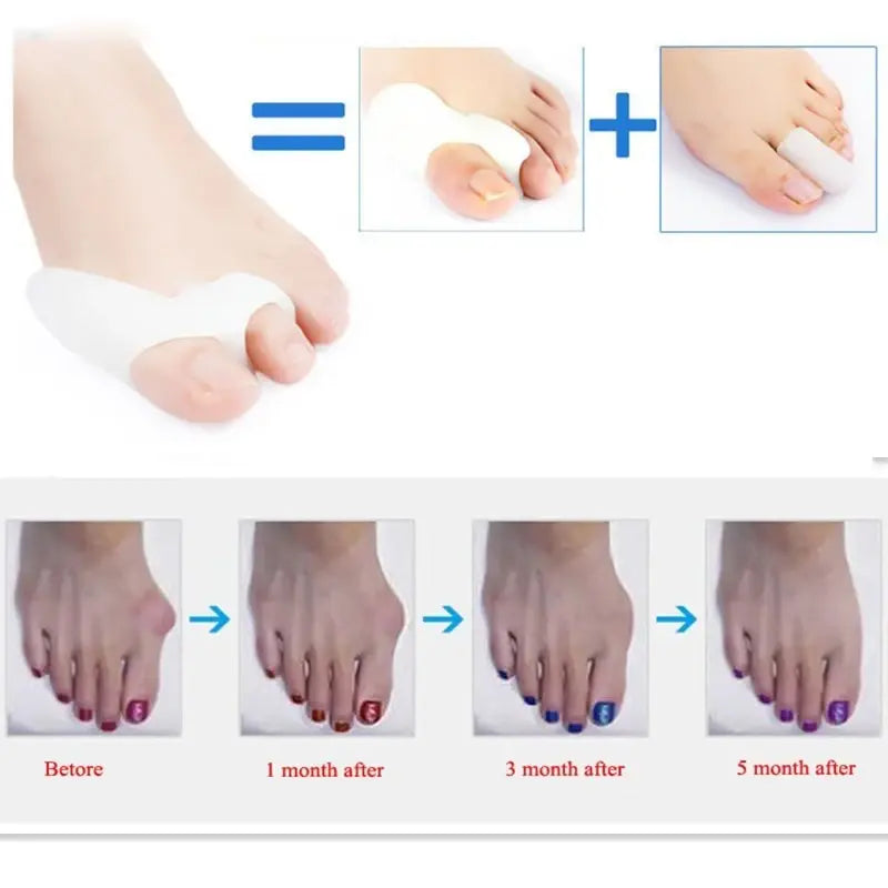 2 stücke profession elle Silikon Gel Zehen Daumen Hallux Valgus Korrektor Glätte isen Separatoren Daumen Zehen Knochen Orthesen Fußpflege-Tool